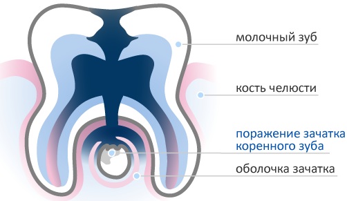 Картинки по запросу кариес молочных повреждение зачатков