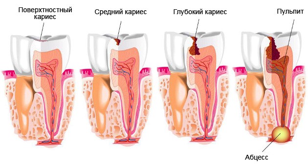 Картинки по запросу кариес стадии развития